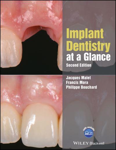 Implant Dentistry At a Glance