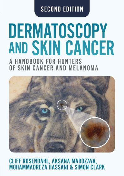 Dermatoscopy and Skin Cancer