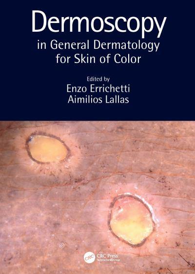 Dermoscopy in General Dermatology For Skin of Color